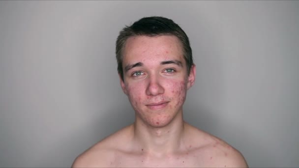 Teenager Mit Pubertät Akne Problem — Stockvideo