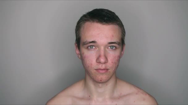 Menino Adolescente Com Problema Acne Puberdade — Vídeo de Stock