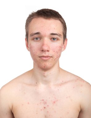 Beyaz arka plan üzerinde cilt sorunu ile yakışıklı genç 