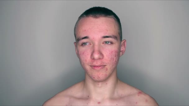 Teenage Boy Puberty Acne Problem — Stock Video
