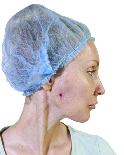 Photo Series Cosmetology Complications Wound Fistula Curettage Cheek Removal Badly — Stock Photo, Image