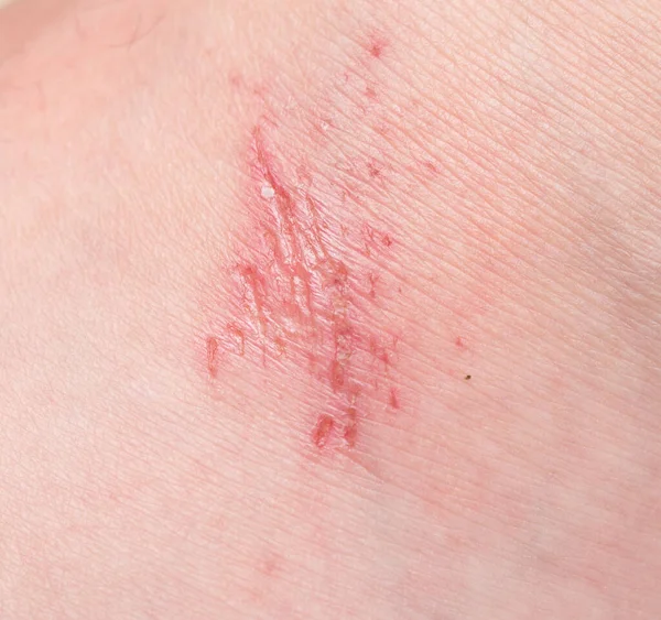 Πληγή Στο Ανθρώπινο Δέρμα — Φωτογραφία Αρχείου