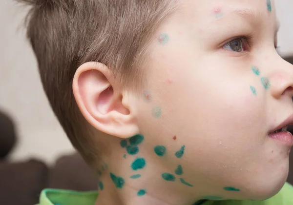 Young Boy Chicken Pox — Stock Photo, Image