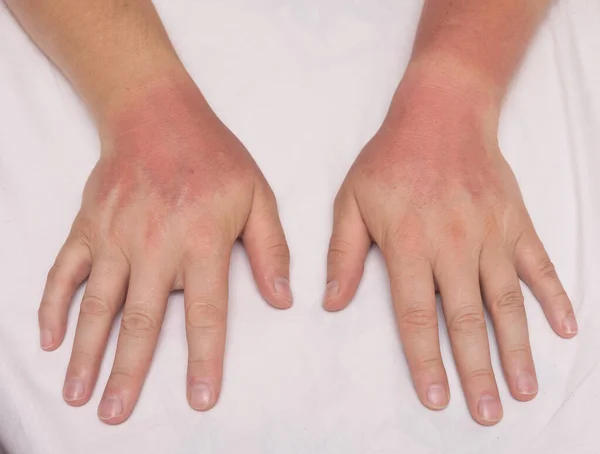 Ręce Mężczyzn Oparzeniach Słonecznych — Zdjęcie stockowe
