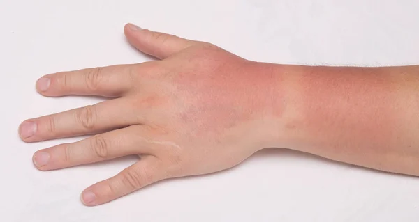 日焼け後の男性の手 — ストック写真
