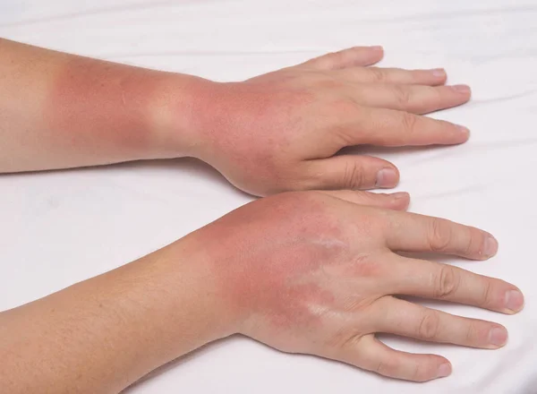Homens Mãos Após Queimadura Solar — Fotografia de Stock