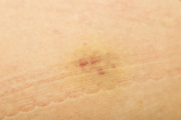 Soft Bruises Injection — Stock Photo, Image
