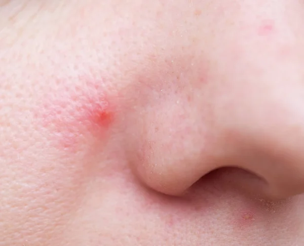 Close Shot Acne Woman Face — Stock Photo, Image