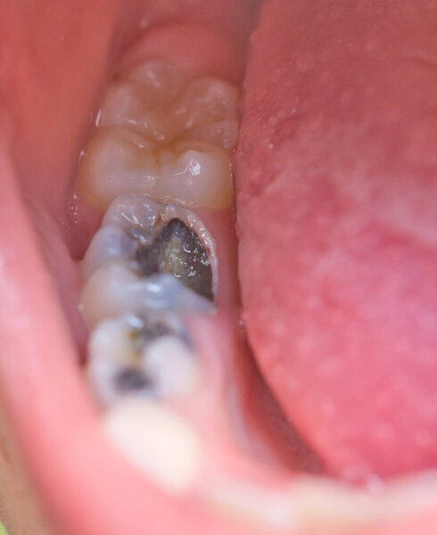 Крупный план кариеса
