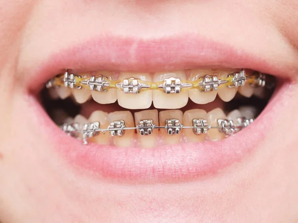 Gros Plan Des Dents Avec Des Accolades — Photo