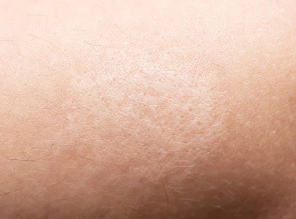 Close Shot Burn Skin — Stock Photo, Image