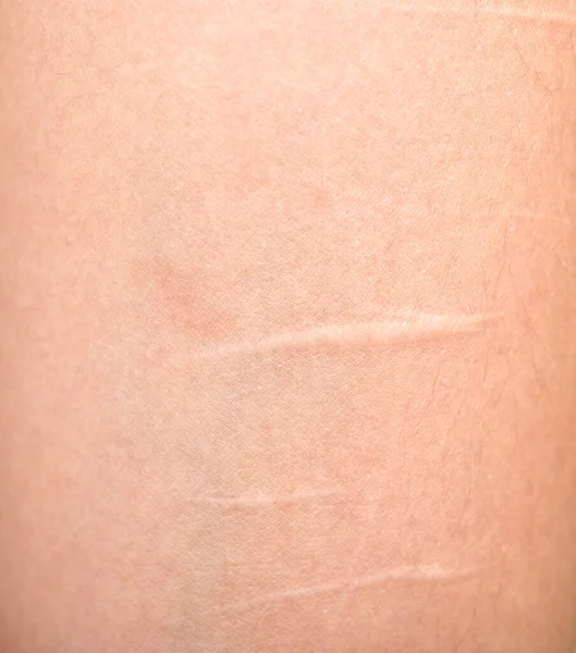 Scars Human Skin — Stock Photo, Image