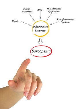 Five Causes of Sarcopenia clipart