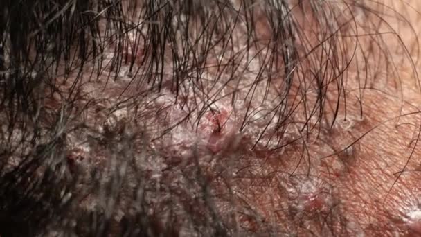 Wounded Skin Texture Close Footage — Stock Video