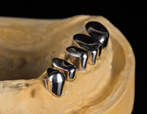 Металлическая Зубная Коронка Гипсовой Модели — стоковое фото