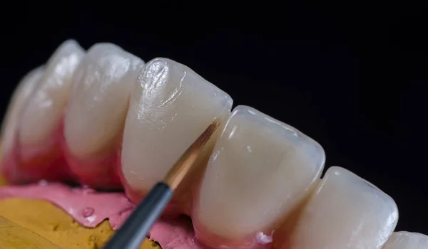 Οδοντίατρος Εφαρμοσμένος Γάνωμα Στην Κεραμική Κορώνα — Φωτογραφία Αρχείου