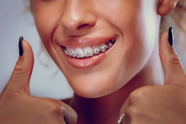 Visão Próxima Mulher Sorridente Com Aparelho Nos Dentes — Fotografia de Stock