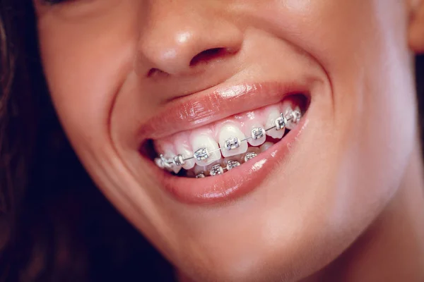 Zamknij Widok Uśmiechający Się Kobiety Szelkami Zęby — Zdjęcie stockowe