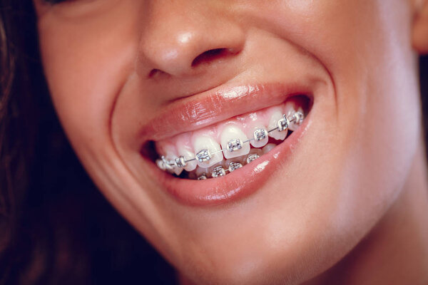 Close view of smiling woman with braces on teeth