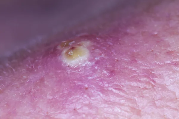 Purulent Pimple Human Skin — Stock Photo, Image