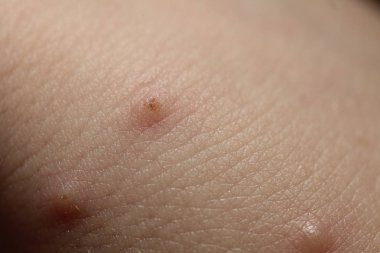 cilt çocuk böcek ısırıkları