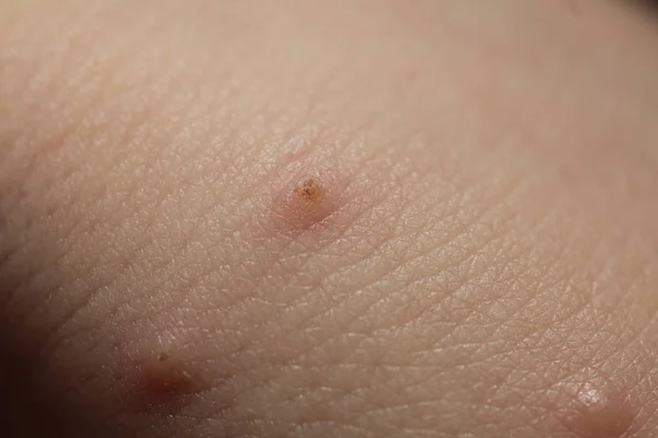 Insect bites on  skin  child — Stock Photo, Image