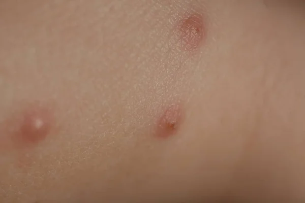 Picadas de insetos na criança da pele — Fotografia de Stock