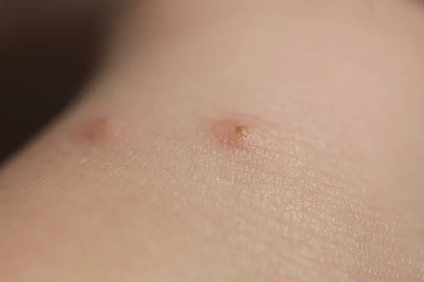 Picadas de insetos na criança da pele — Fotografia de Stock