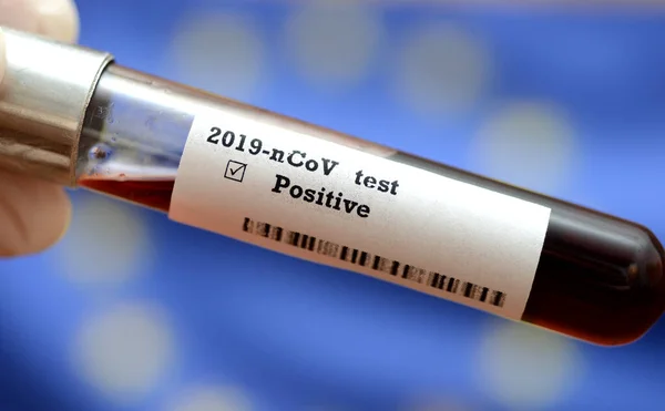 Campione Sangue Coronavirus 2019 Ncov Virus Epidemico Sindrome Respiratoria Foto — Foto Stock
