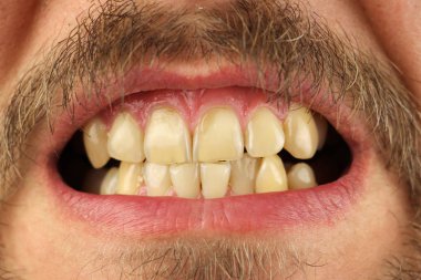 kapalı insan düzensiz dişler sırıtış, portre, makro