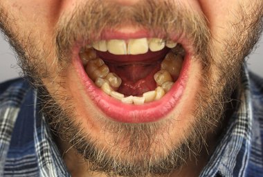 bir sakallı adam alt dişler, closeup diş muayenesi için ağzını açtı