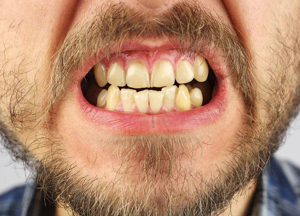 Fechado Humano Desigual Dentes Sorriso Pequena Lacuna Close — Fotografia de Stock