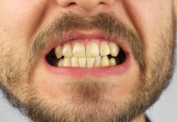 Закрытые Человеческие Неровные Зубы Усмехаются Крупным Планом — стоковое фото