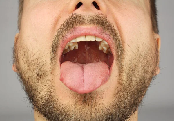 Mann Mit Bart Öffnete Seinen Mund Für Zahnärztliche Untersuchung Nahaufnahme — Stockfoto