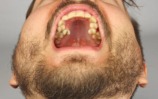 男子与胡子打开他的嘴牙科检查上牙 — 图库照片