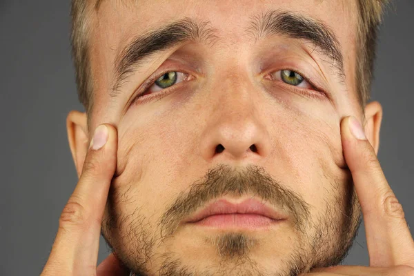 Portrait Tired Man Pulls Corners Eyes Fingers Changes Shape Eyes — Stock Photo, Image