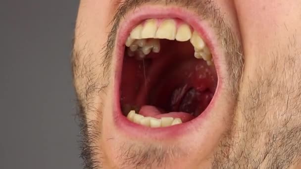 Άνθρωπος Μια Γενειάδα Ανοίγει Στόμα Του Για Ιατρική Οδοντιατρική Εξέταση — Αρχείο Βίντεο