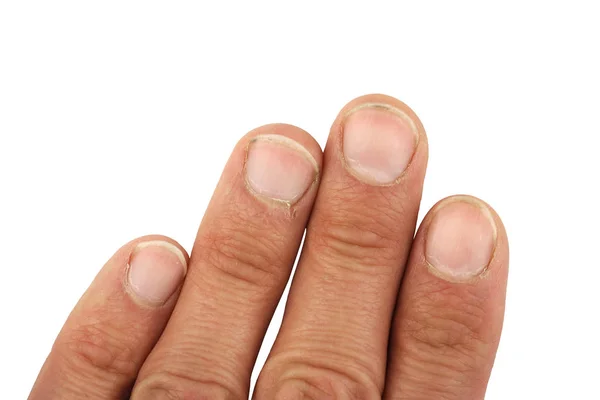 四男性手指的一只手 与污垢下的指甲 特写宏 — 图库照片