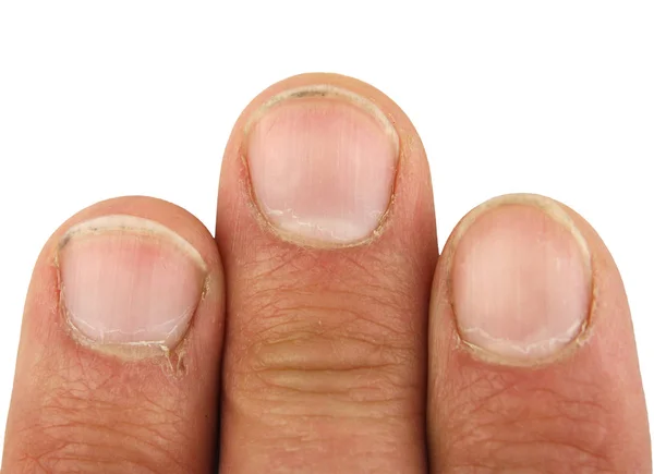 Três Dedos Masculinos Uma Mão Desarrumado Com Sujeira Sob Unhas — Fotografia de Stock