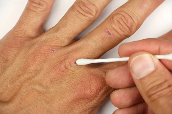 Θεραπεία Του Μικρή Πληγή Ανθρώπινο Χέρι Λευκό Βαμβάκι Λήψη Φαρυγγικού — Φωτογραφία Αρχείου