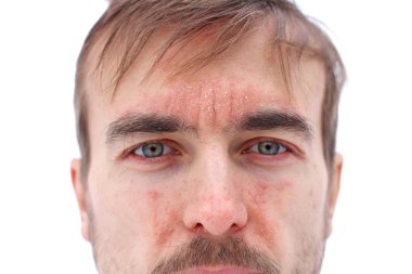 head of sick man with red allergic reaction on facial skin, redness and peeling psoriasis on nose, forehead and cheeks, seasonal skin problem, close-up, white background clipart