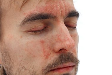 yüz cilt, kızarıklık ve burun, alın ve yanaklar, mevsimsel cilt sorunu, yan görünüm, beyaz arka plan üzerinde peeling sedef hastalığı ile kapalı gözleri ile hasta adam başkanı
