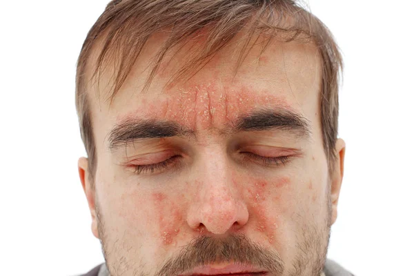 Cabeza del hombre enfermo con los ojos cerrados con reacción alérgica roja en la piel facial, enrojecimiento y descamación de la psoriasis en la nariz, frente y mejillas, problema estacional de la piel, fondo blanco — Foto de Stock