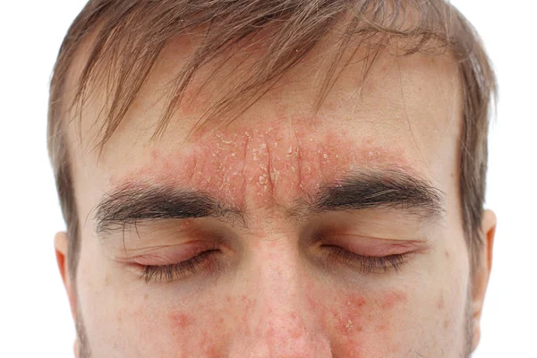 Cabeça de homem doente com olhos fechados com reação alérgica vermelha na pele, vermelhidão e descamação psoríase no nariz, testa e bochechas, problema de pele sazonal, close-up, fundo branco — Fotografia de Stock