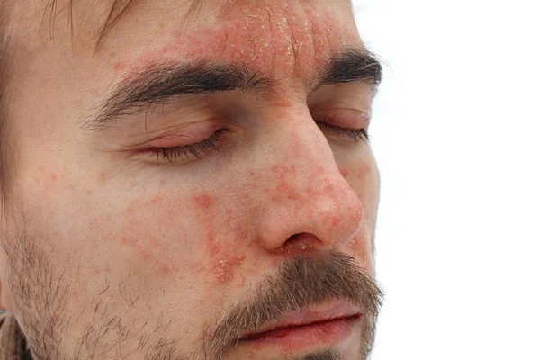 Head of sick man with closed eyes with red allergic reaction on facial skin, redness and peeling psoriasis on nose, forehead and cheeks, seasonal skin problem, side view, white background — Stock Photo, Image