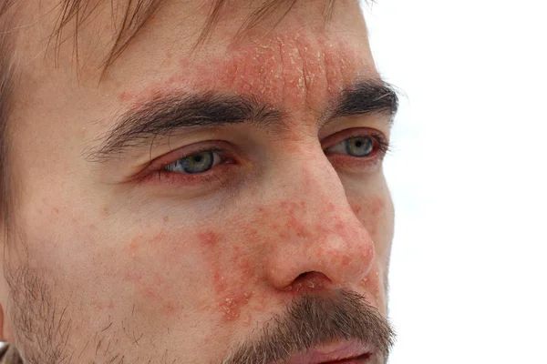 Kopf eines kranken Mannes mit roter allergischer Reaktion auf Gesichtshaut, Rötung und Schuppenflechte an Nase, Stirn und Wangen, saisonales Hautproblem, Seitenansicht, weißer Hintergrund Stockfoto