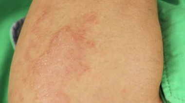 insan kol, kızarıklık ve dirsek, mevsimsel cilt sorunu, yakın çekim makro sedef soyma kırmızı alerjik reaksiyon ile elini çizikler 