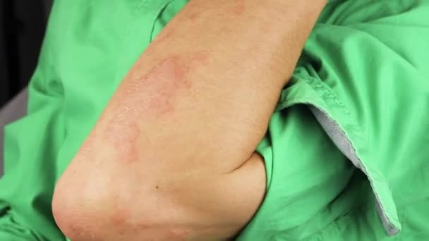 Sick Man Scratches His Hand Red Allergic Reaction Arm Redness — Stock Video