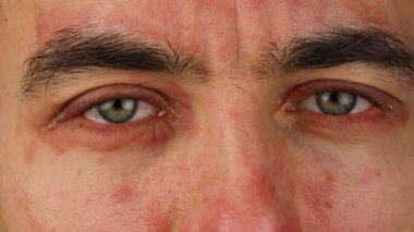 insan kırmızı alerjik reaksiyon, kızarıklık ve yüz deride peeling sedef hastalığı ile gözlerinin iki çizikler, mevsimsel dermatoloji sorunu, yakın çekim  
