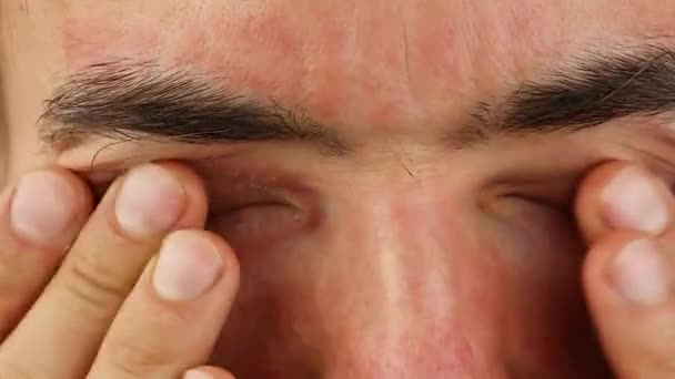 Чоловік Дме Подряпає Очі Червоною Алергічною Реакцією Почервонінням Пілінговим Псоріазом — стокове відео